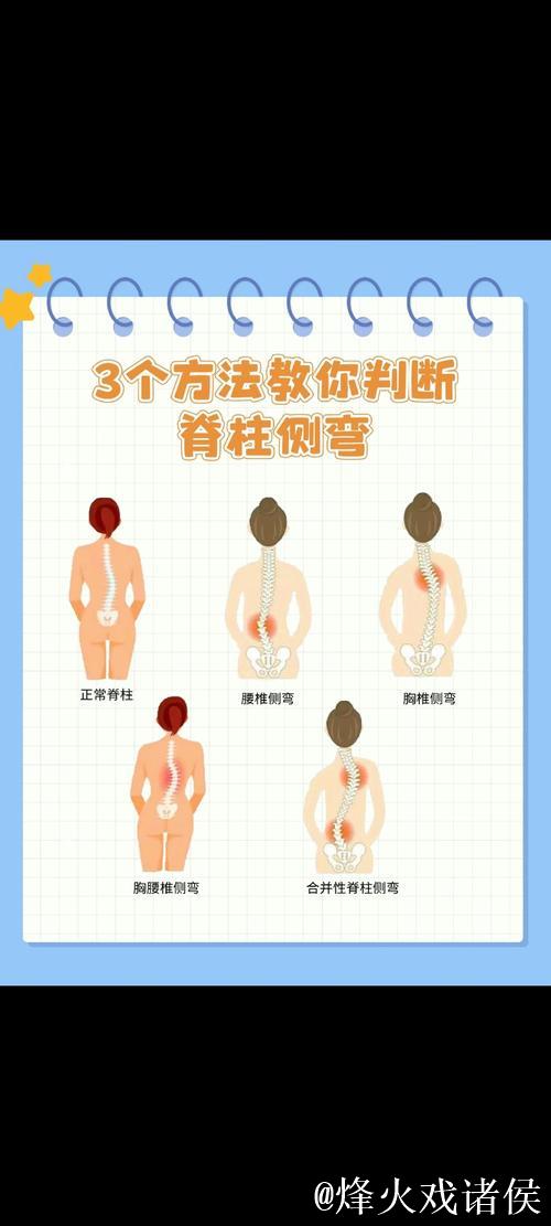 1分钟科普站丨预防青少年脊柱侧弯 这2个动作太管用了 1分钟科普站丨预防青少年脊柱侧弯 这2个动作太管用了